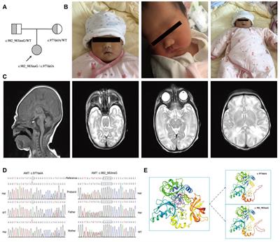 The Mutation Analysis of the AMT Gene in a Chinese Family With Nonketotic Hyperglycinemia